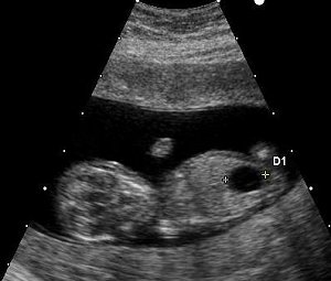 Ultrasound of fetus with Down syndrome. Photo: Compagnion. Source: Wikimedia Commons.